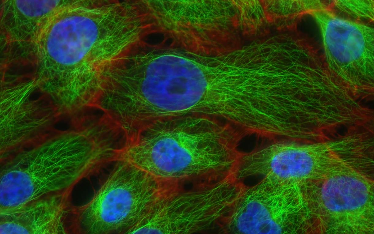 A microscopic image of stress fibers and microtubules in human breast cancer cells.