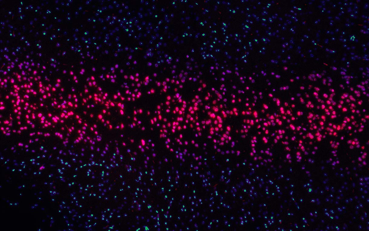 Illustration of X-ray sources delivering tumor-killing radiation.